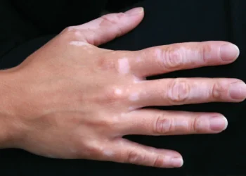 The Spiritual Meaning of Vitiligo