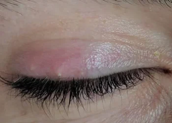 The Spiritual Meaning of a Stye